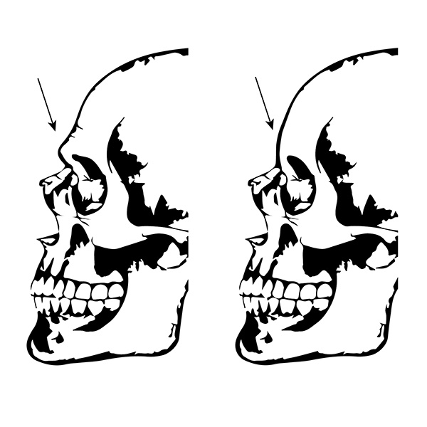 forehead reduction illustration