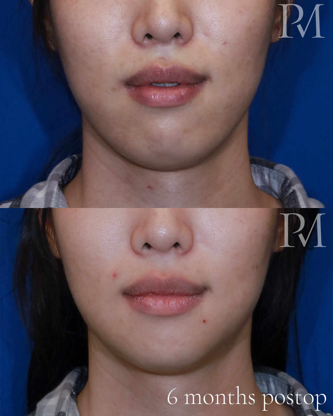 jaw feminization before and after