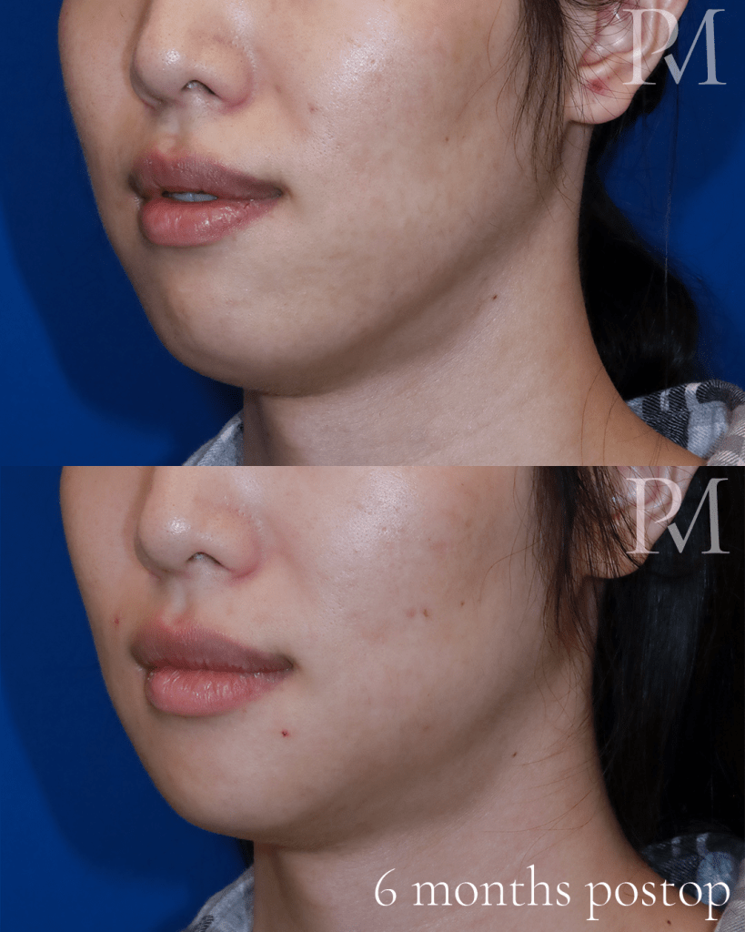 jaw feminization before and after