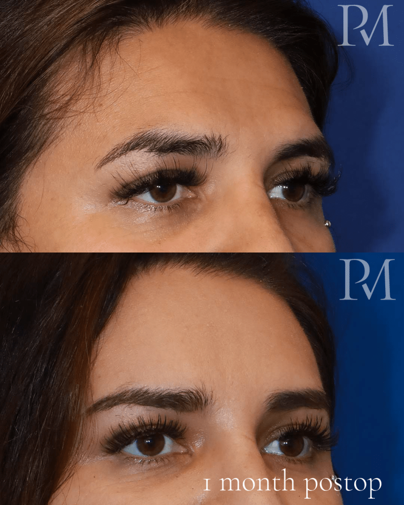 forehead feminization before and after