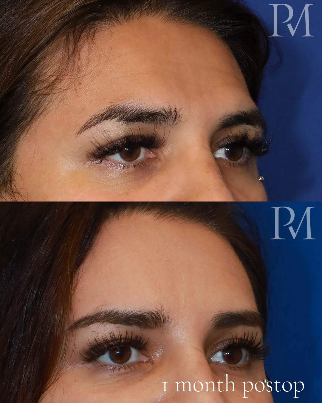 brow bone reduction before after