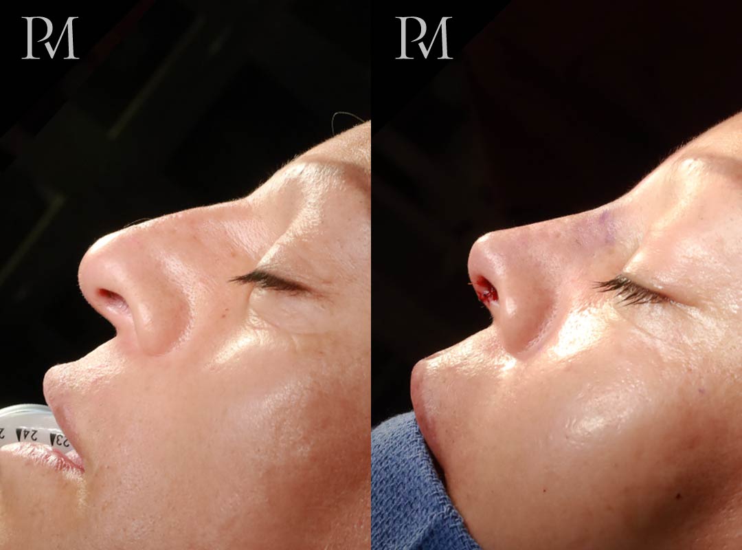 Mittermiller feminizing rhinoplasty FFS nose surgery