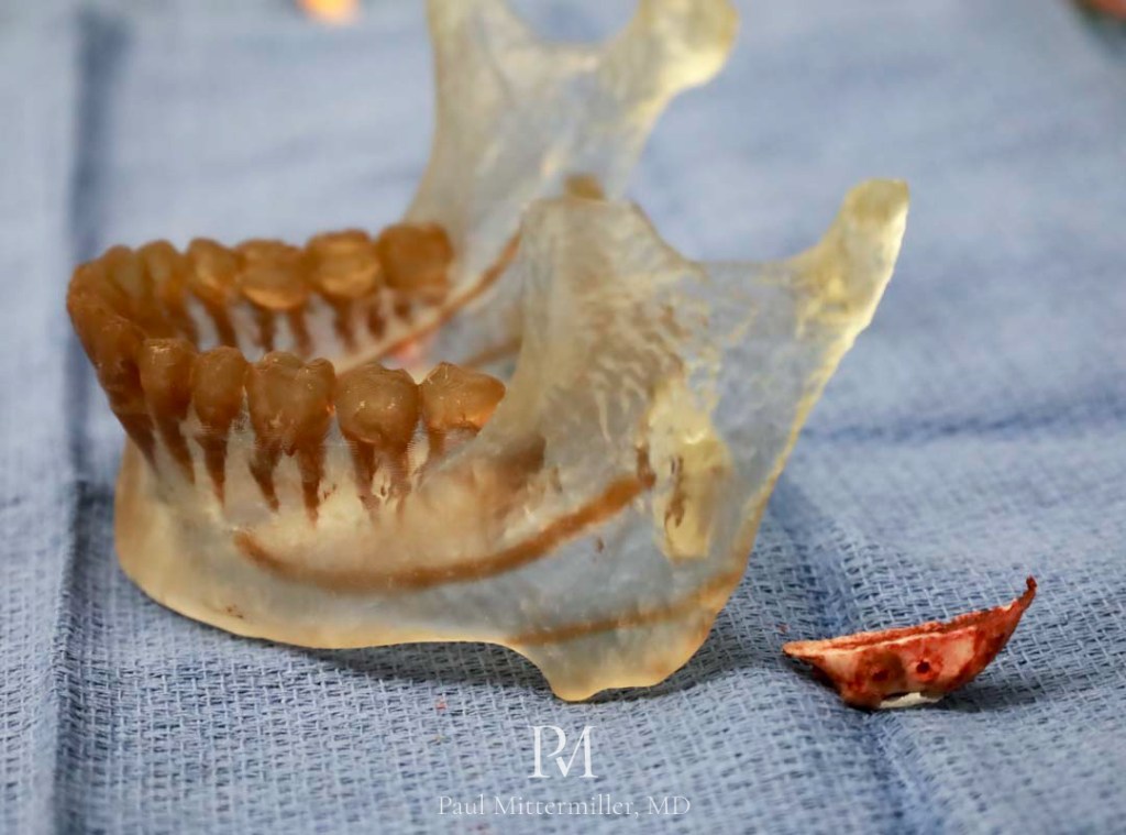 ffs jaw angle resection
ffs mandibular osteotomy