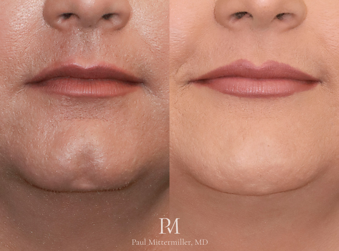 cleft chin feminization fat grafting Mittermiller