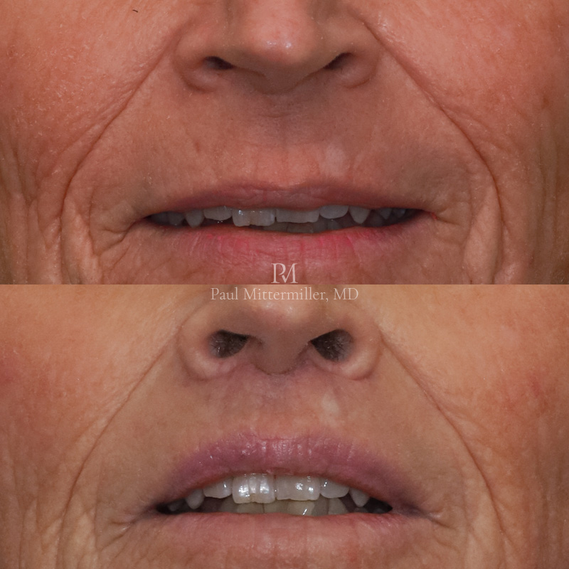 Lip lift before after closeup
Lip lift scar
Mittermiller lip lift before after photos closeup
Mittermiller lip lift before and after photographs closeup
