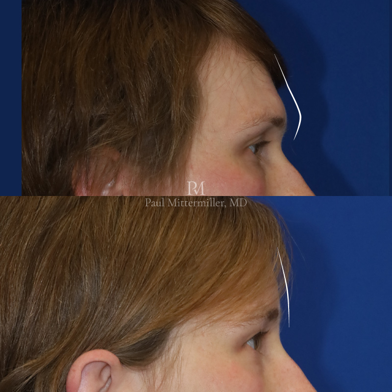 Brow bone reduction before after
Type 3 forehead before after
Forehead feminization before after
Brow bossing before after photos