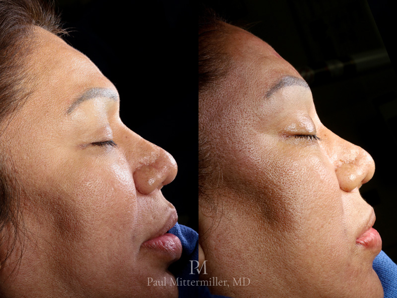 Revision facial feminization surgery before after Revision FFS before after Mittermiller revision facial feminization surgery before after Mittermiller revision FFS before after photos