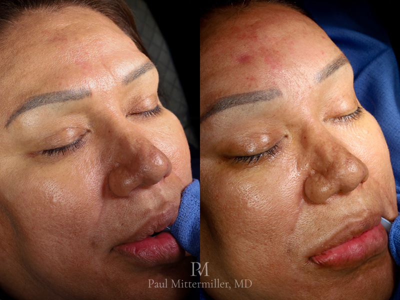 Revision orbital rim contouring before after
Forehead feminization implant photo Mittermiller revision brow bone before after photos
Mittermiller revision orbital contouring before after photos