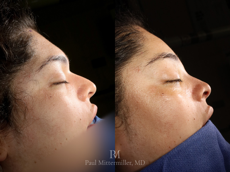 Type 3 brow bone reduction before after Closed rhinoplasty before after Mittermiller type 3 brow bone reduction before after Mittermiller brow feminization before after photos
