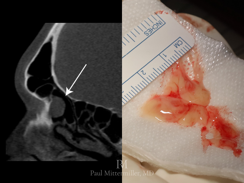 Ethmoid mass during facial feminization surgery Mucous retention cyst photo