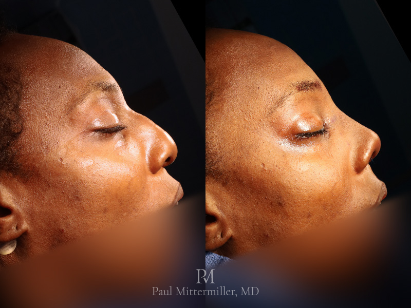 Type 3 brow bone reduction before after Rhinoplasty before after Mittermiller type 3 brow bone reduction before after Mittermiller rhinoplasty before after photos Reduction rhinoplasty photos