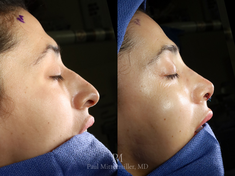 Feminizing rhinoplasty before after Mittermiller rhinoplasty before after Tip-defining rhinoplasty before after