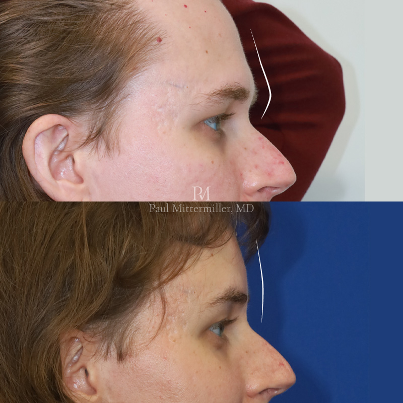 Type 3 brow bone reduction before after Mittermiller type 3 brow bone reduction before after Mittermiller brow ridge feminization before after photos