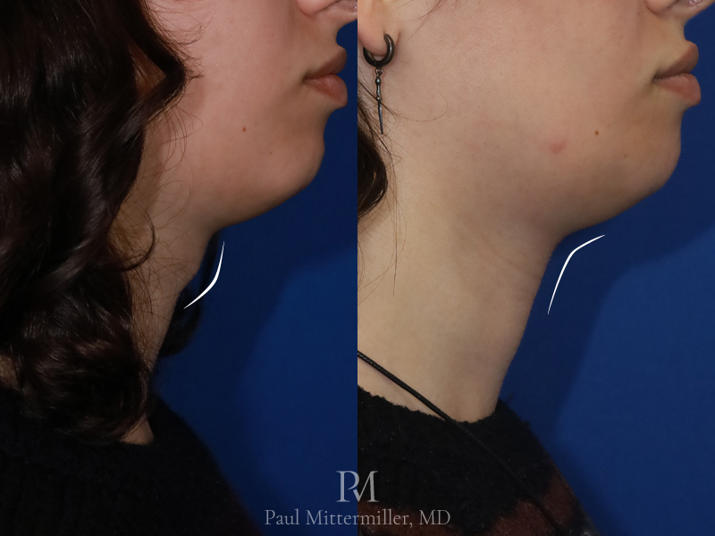 Tracheal shave before after looking straight Thyroid cartilage reduction scar before after Adam’s apple reduction before after Mittermiller tracheal shave scar before after photos