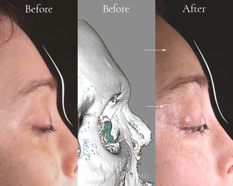 Revision facial feminization surgery before after Revision FFS before after Revision brow bone reduction FFS Mittermiller revision facial feminization surgery before after Mittermiller revision FFS before after photos Mitttermiller revision brow bone reduction Type 1 to type 3 conversion