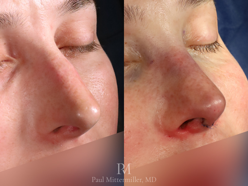Feminizing reduction rhinoplasty before after Mittermiller feminizing rhinoplasty before after photos Dorsal reduction rhinoplasty before after photos Mittermiller feminizing reduction rhinoplasty before after photos