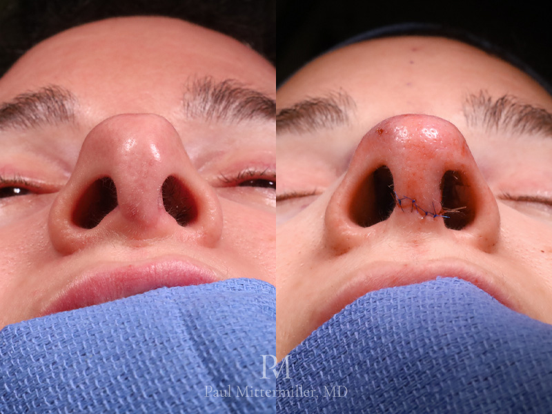 Mittermiller secondary rhinoplasty photos Mittermiller stair-step rhinoplasty incision photo