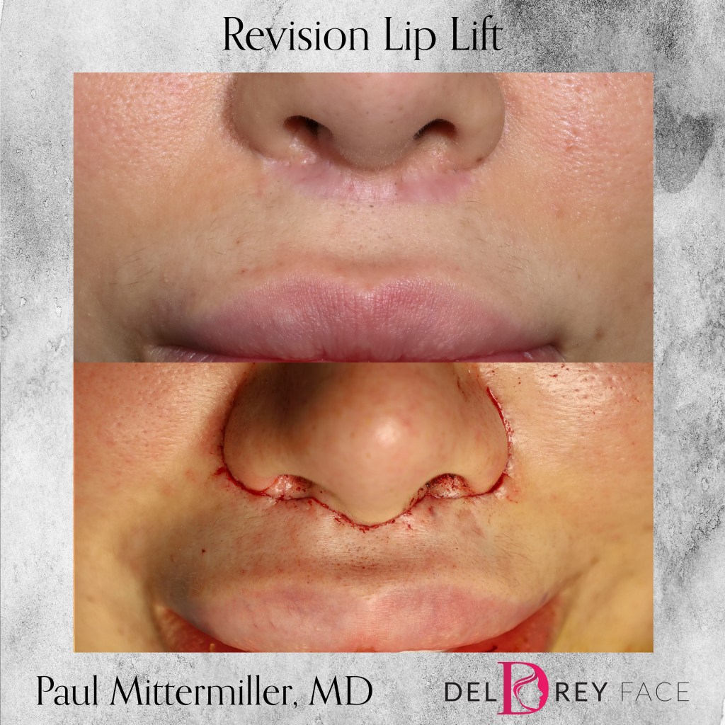 revision lip lift lip lift scar lip lift before after Mittermiller lip lift