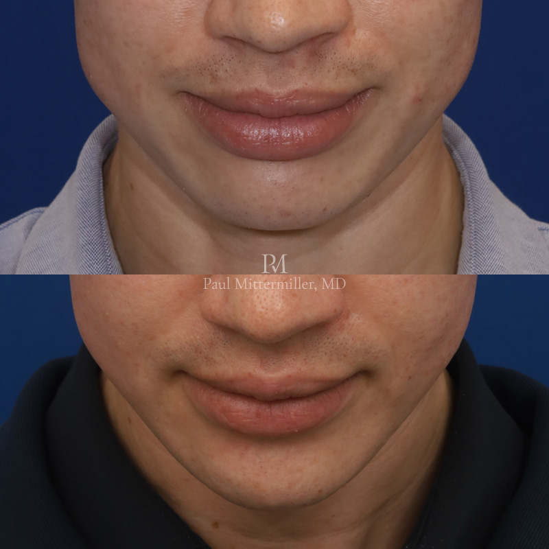 Mittermiller strengthening genioplasty photos Mittermiller masculinizing genioplasty photo