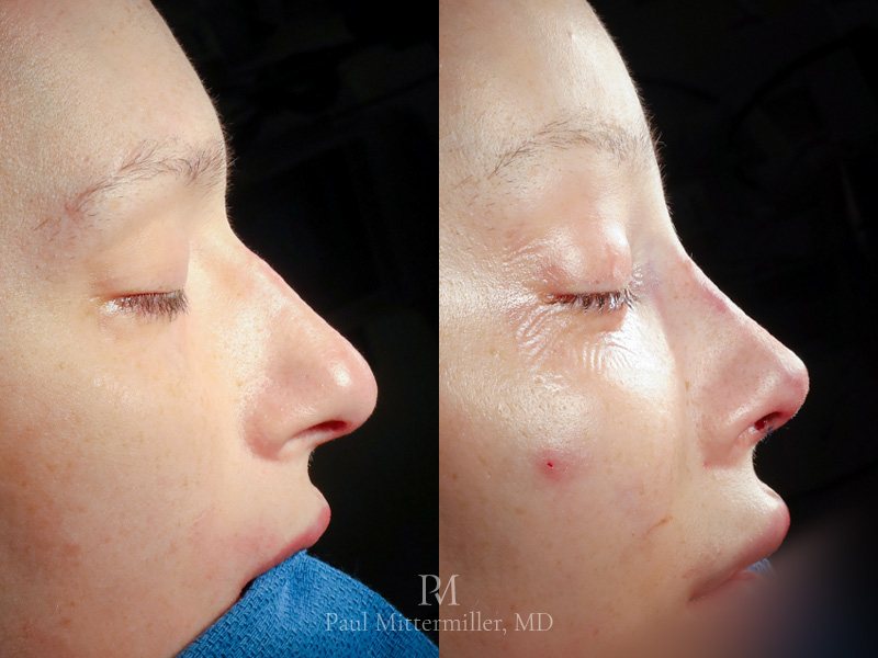 Brow bone reduction before after rhinoplasty before after Type 3 reduction and rhinoplasty before after Mittermiller brow bone before after photos Mittermiller brow lift before after FFS before and after photographs