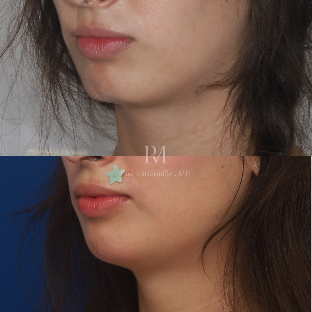 Genioplasty before after
Mittermiller genioplasty photos
Mittermiller chin surgery before after photos