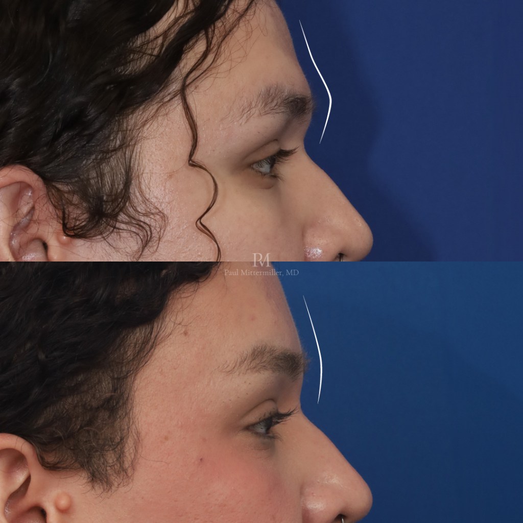 Brow bone reduction before after Mittermiller type 3 reduction photos Mittermiller forehead feminization before after photos
