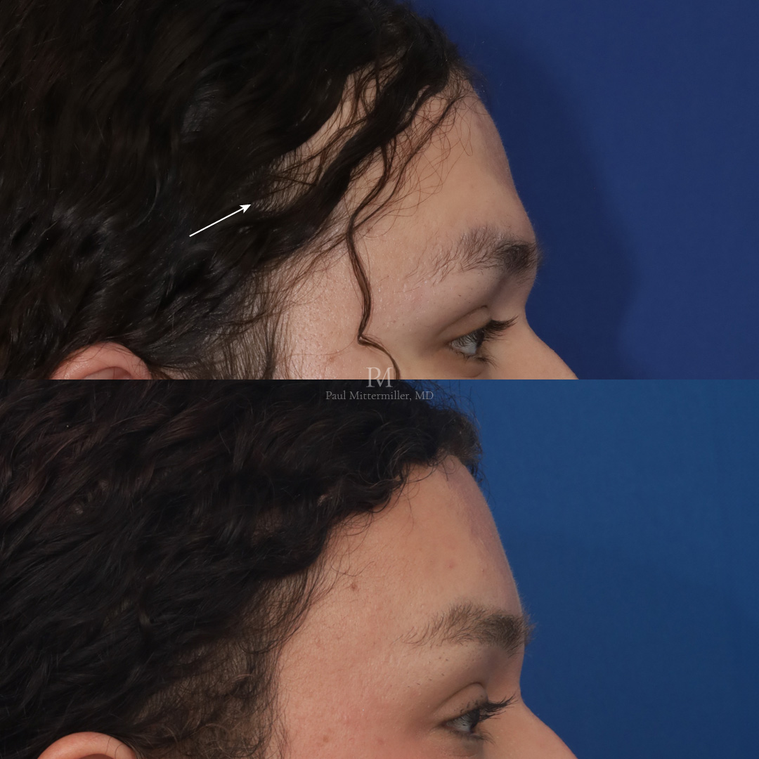 Mittermiller forehead feminization before after photos Surgical hairline reshaping amount before after Mittermiller hairline reshaping before after photos photographs