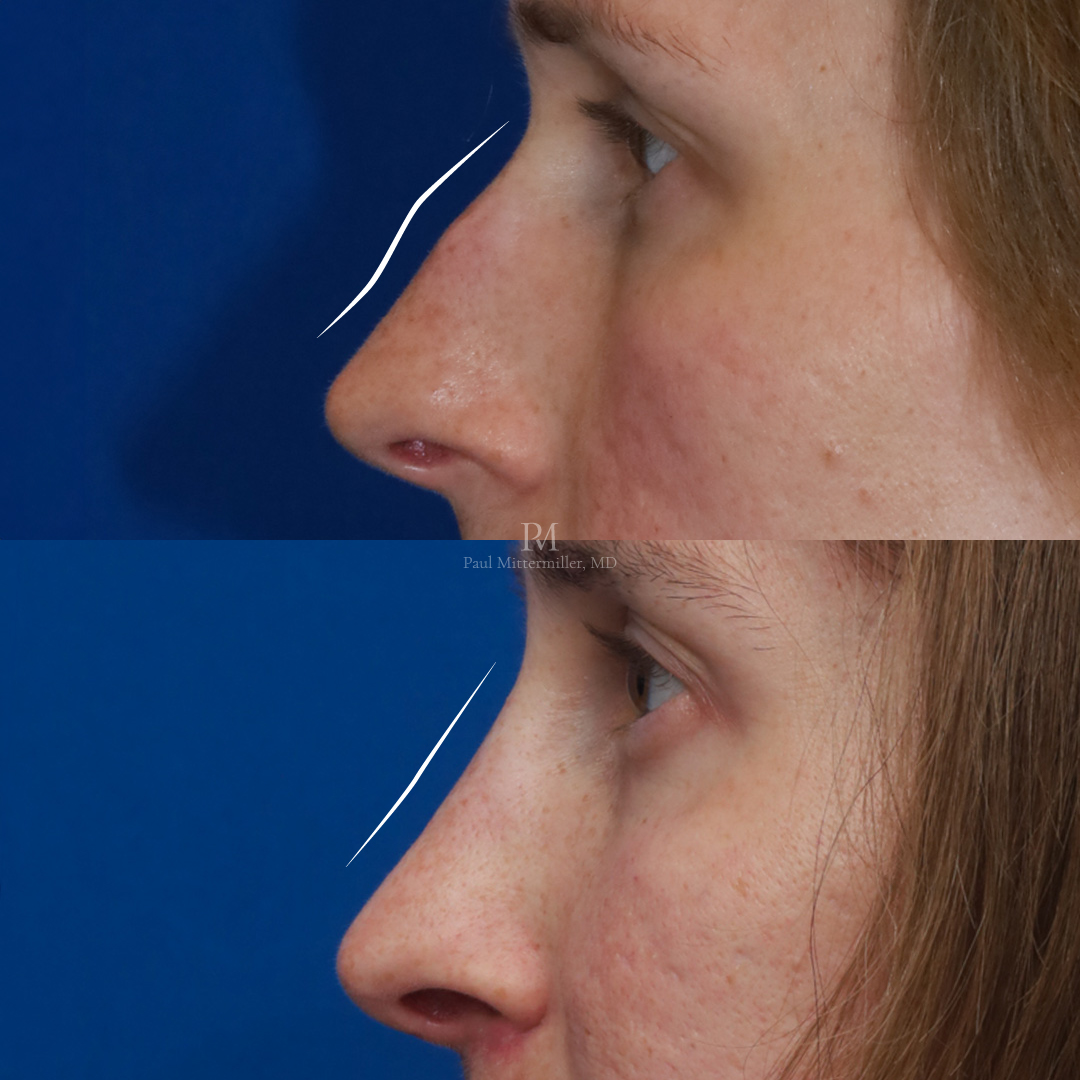Feminizing rhinoplasty before after Mittermiller rhinoplasty before after Dorsal reduction rhinoplasty before after Reduction rhinoplasty before after photos