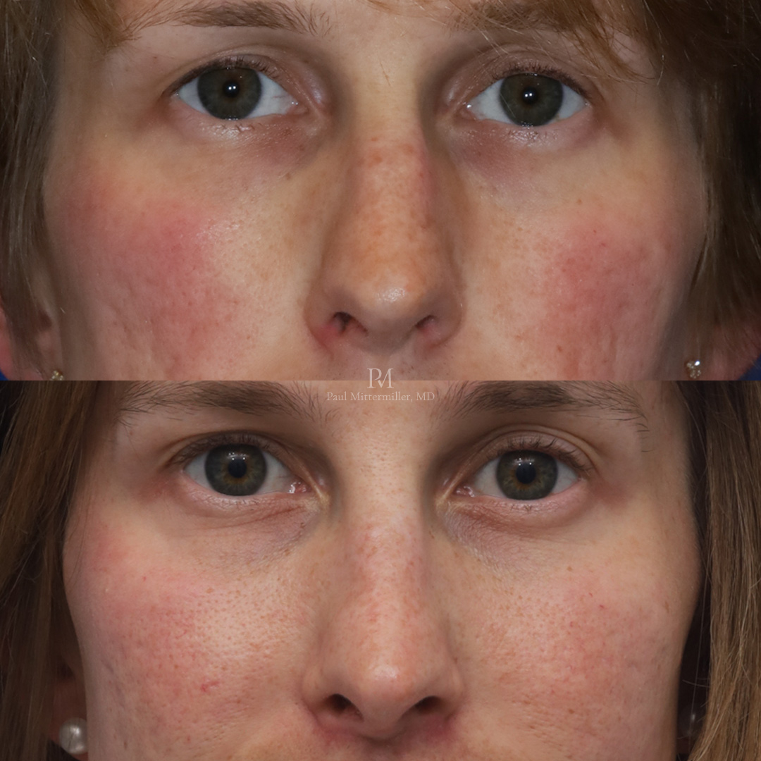 Feminizing reduction rhinoplasty before after
Mittermiller feminizing rhinoplasty before after photos
Dorsal reduction rhinoplasty before after photos
Mittermiller feminizing reduction rhinoplasty before after photos
Reduction rhinoplasty before after photos