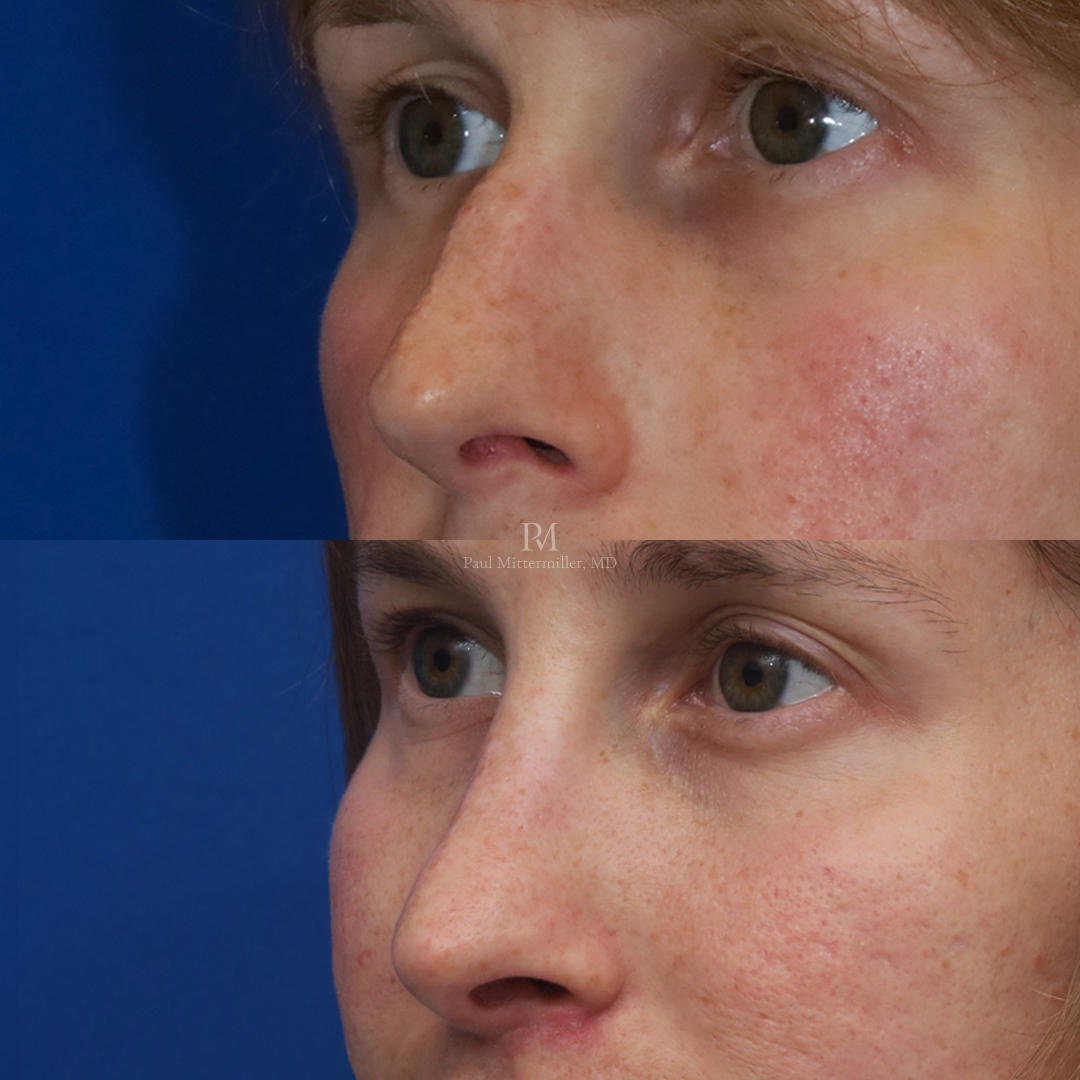Feminizing reduction rhinoplasty before after Mittermiller feminizing rhinoplasty before after photos Dorsal reduction rhinoplasty before after photos Mittermiller feminizing reduction rhinoplasty before after photos Reduction rhinoplasty before after photos