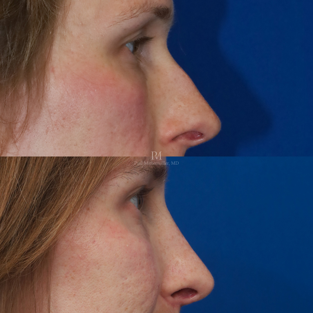 Feminizing reduction rhinoplasty before after Mittermiller feminizing rhinoplasty before after photos Dorsal reduction rhinoplasty before after photos Mittermiller feminizing reduction rhinoplasty before after photos Reduction rhinoplasty before after photos