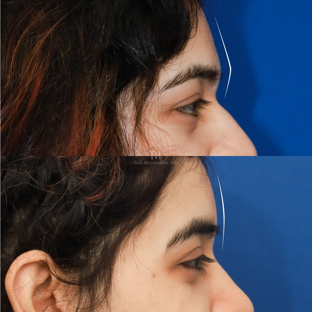 Brow bone reduction before after
Mittermiller type 3 reduction photos
Mittermiller forehead feminization before after photos
