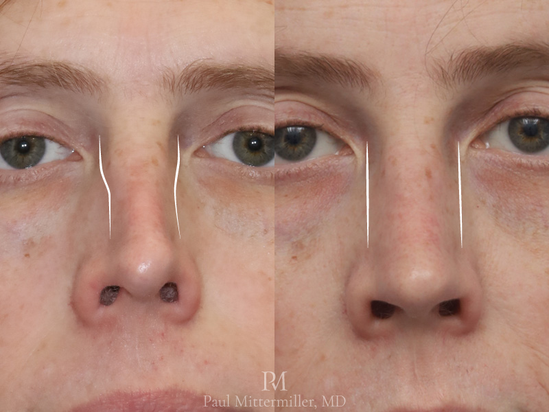 Feminizing reduction rhinoplasty before after Mittermiller feminizing rhinoplasty before after photos Dorsal reduction rhinoplasty before after photos Mittermiller feminizing reduction rhinoplasty before after photos Reduction rhinoplasty before after photos