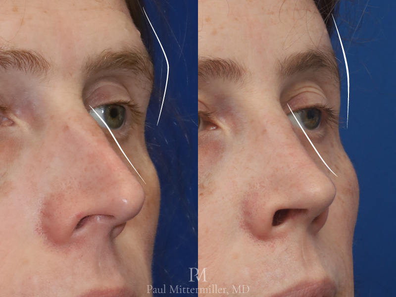 Mittermiller orbital rim reduction Mittermiller dorsal hump reduction