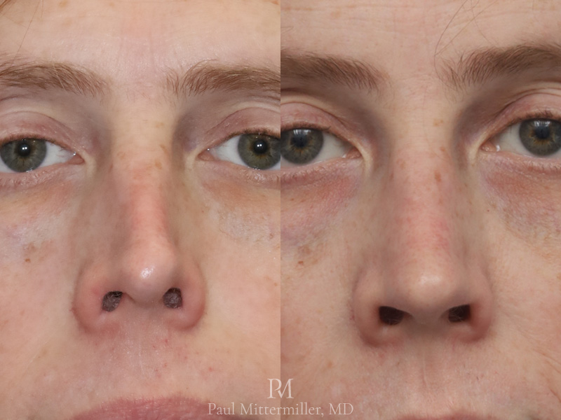 Feminizing rhinoplasty before after
Mittermiller rhinoplasty before after
Dorsal reduction rhinoplasty before after
Reduction rhinoplasty before after photos