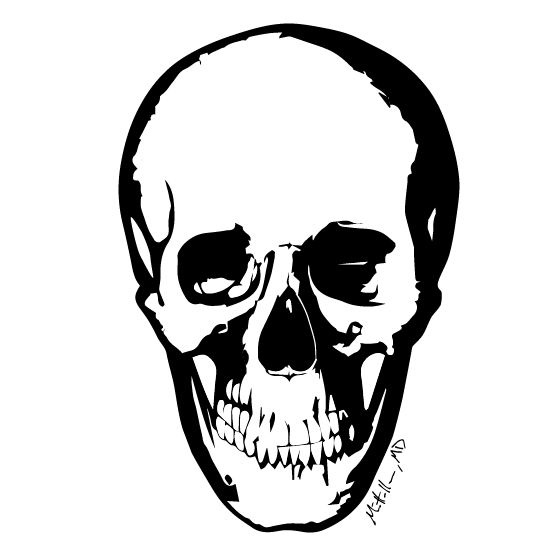Oblique Mandibular Chin-Body Osteotomy for chin narrowing