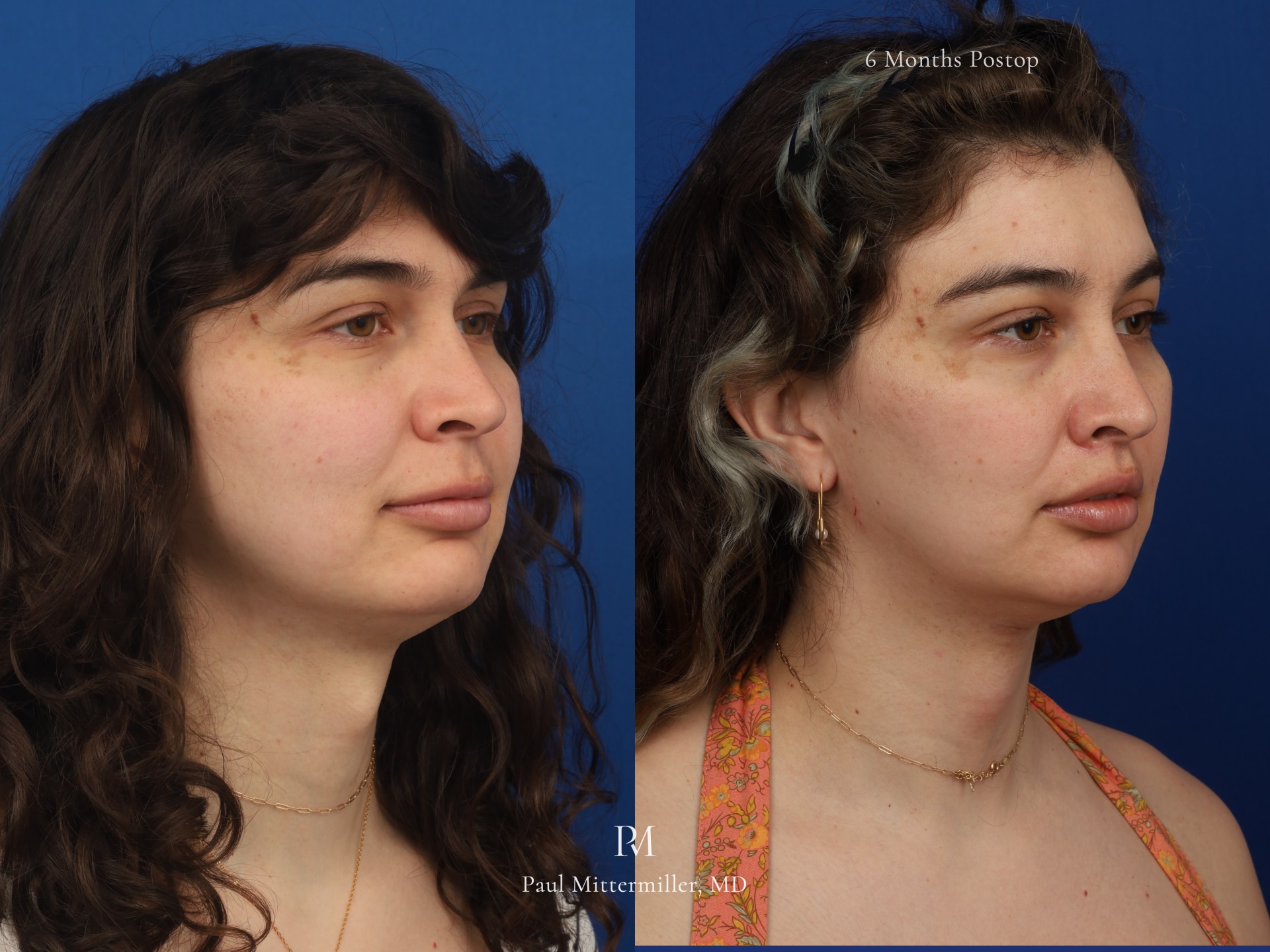 lip lift scar brow bone reduction orbital conoturing brow lift ffs facial feminization surgery before after mittermiller photos photographs pics