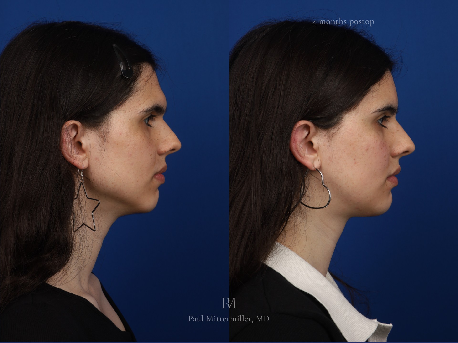 Mittermiller brow bone reduction type 3