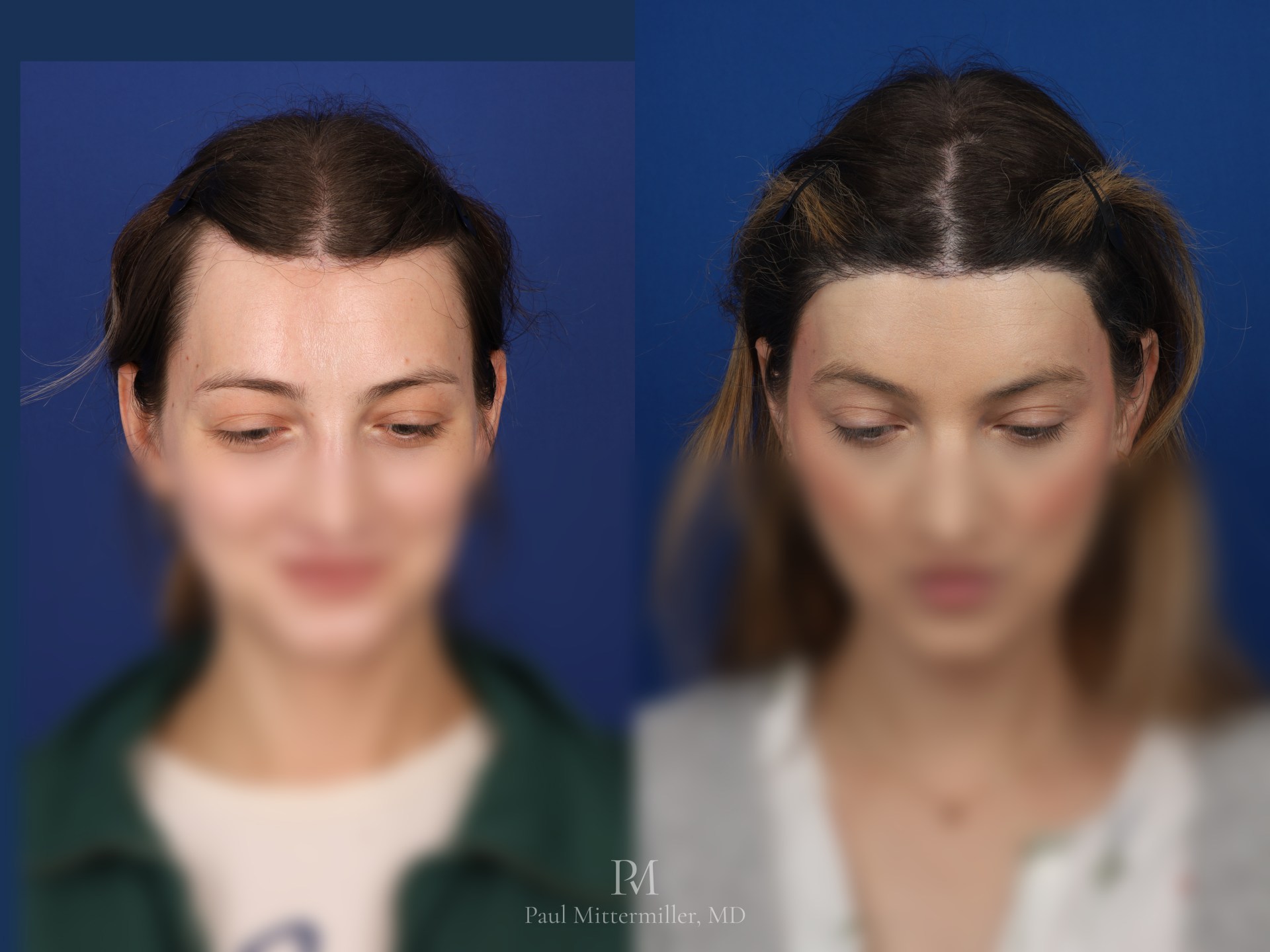 Downward-facing views of of before and after images showing hair transplants for facial feminization surgery (FFS) with Dr. Mittermiller to round the hairline and cover the scar following surgical lowering