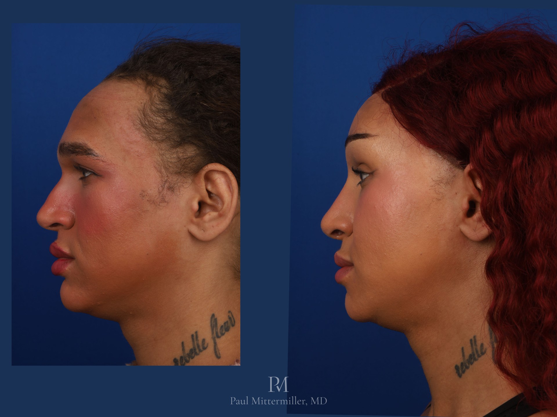 Before and after FFS profile view, highlighting a smooth brow bossing setback, feminized nasal profile, and chin shortening.
