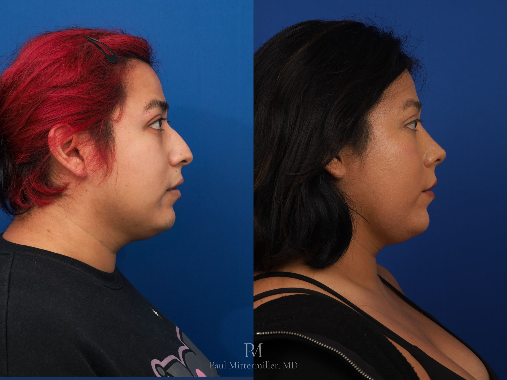 Before and after feminizing rhinoplasty right profile view, demonstrating dorsal hump reduction and subtle tip rotation.